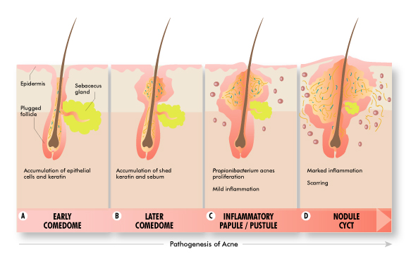 Dr Rachel Ho Get Your Sexy Back Get Rid Of Back Acne In 3 Steps