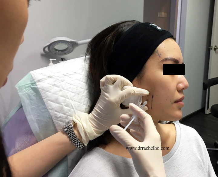 jaw botox reduction into masseter muscle