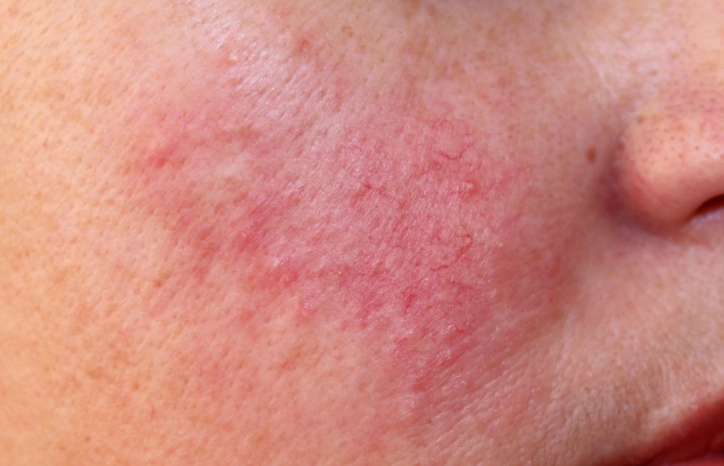 Dr Rachel Ho Rosacea Symptoms Triggers Skincare And Treatments